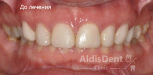 Клинический случай 8. Имплантация, гнатология, ортопедия