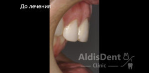 Клинический случай 8. Имплантация, гнатология, ортопедия