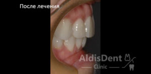 Клинический случай 8. Имплантация, гнатология, ортопедия