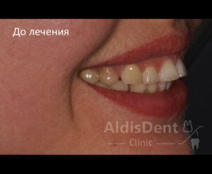 Клинический случай 7. Имплантация, гнатология, ортопедия