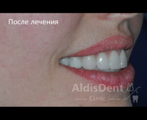 Клинический случай 7. Имплантация, гнатология, ортопедия