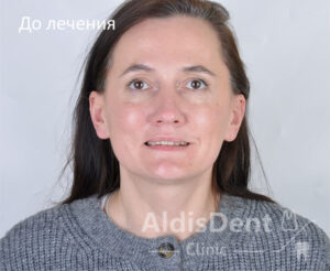 Клинический случай 6. Гнатология, имплантация, ортопедия