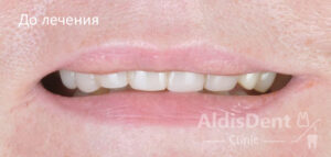 Клинический случай 6. Гнатология, имплантация, ортопедия