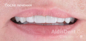 Клинический случай 6. Гнатология, имплантация, ортопедия