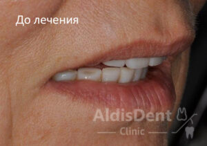 Клинический случай 5. Имплантация, гнатология, ортопедия