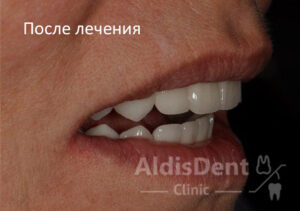 Клинический случай 5. Имплантация, гнатология, ортопедия