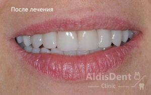 Клинический случай 4. Имплантация, гнатология, ортопедия