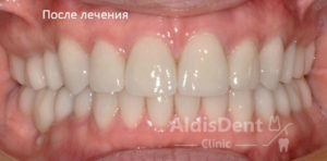 Клинический случай 8. Имплантация, гнатология, ортопедия