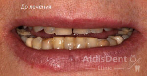 Клинический случай 12. Гнатология, эстетика