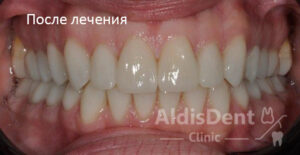 Клинический случай 11. Гнатология, эстетика