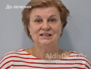 Клинический случай 5. Имплантация, гнатология, ортопедия