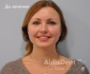 Клинический случай 7. Имплантация, гнатология, ортопедия