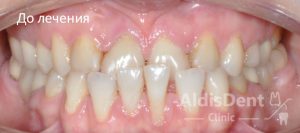 Клинический случай 1. Гнатология, ортодонтия, ортопедия